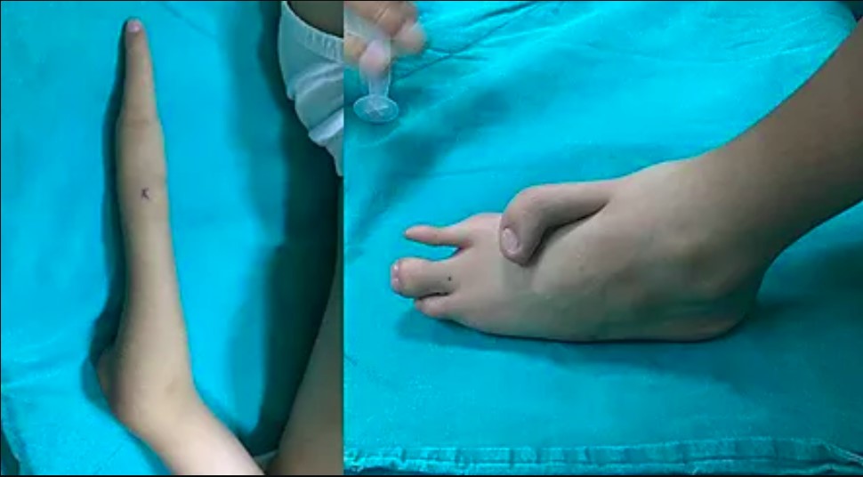 Parmak Farkıyla Hayatı Değişti (SÖZCÜ)